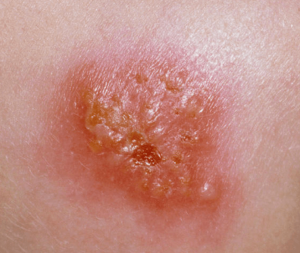 bacterial rash