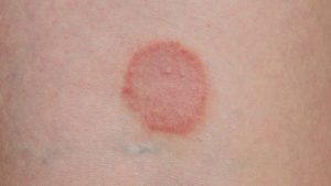 Circular Rash: Common Causes That Aren't Ringworm